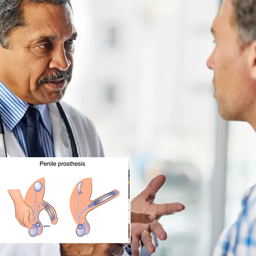 Why Choose  Surgery Center of Fremont 
for Your Malleable Penile Implant